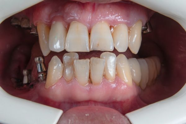 Comment un implant dentaire transformera votre sourire à Lyon 8ᵉ
