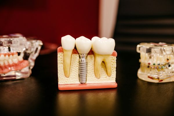 Comment un implant dentaire transformera votre sourire à Lyon 8ᵉ